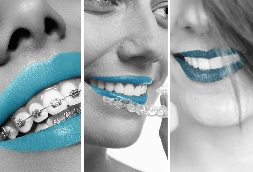 Aparat ortodontyczny – jakie rodzaje zakładamy w naszych gabinetach?